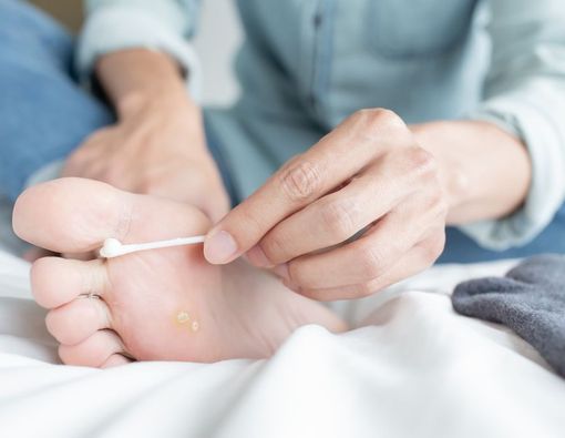 5 Pilihan Obat Kutu Air yang Ampuh, Bisa Dibeli di Apotek