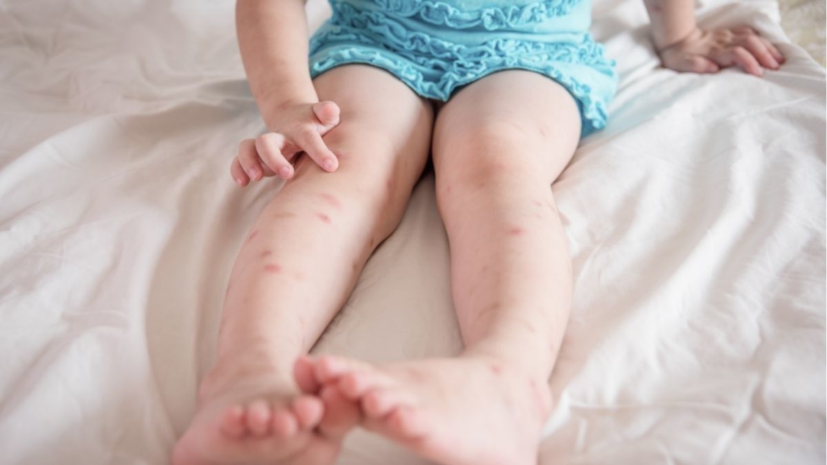 Alasan Medis Bentol Akibat Gigitan Nyamuk Terasa Gatal