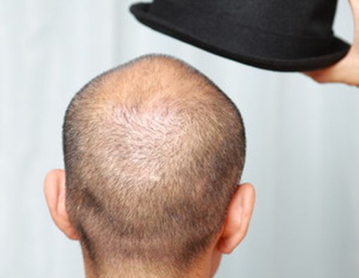 Benarkah Topi Sebabkan Kebotakan Permanen pada Pria?