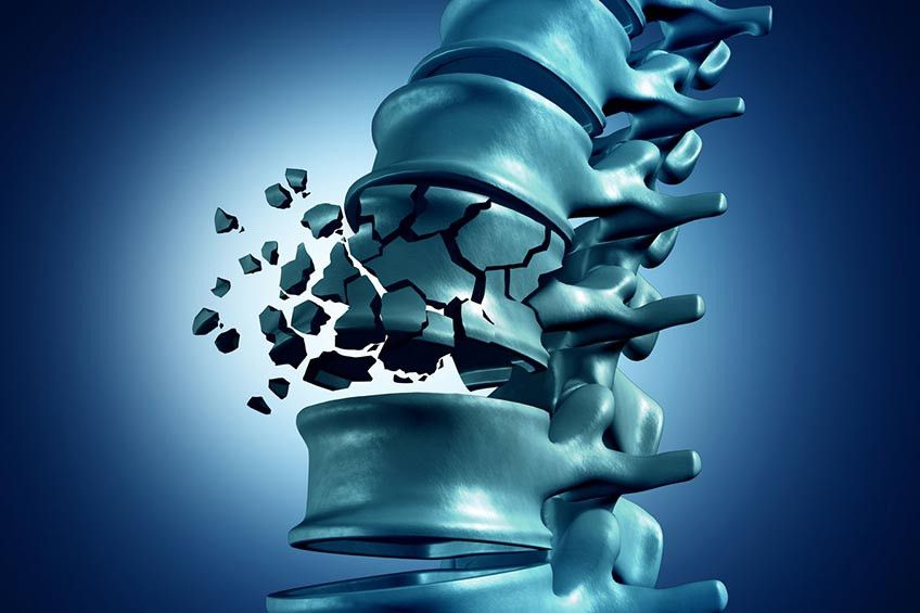 Inilah Dampak Buruk Osteoporosis bagi Tulang