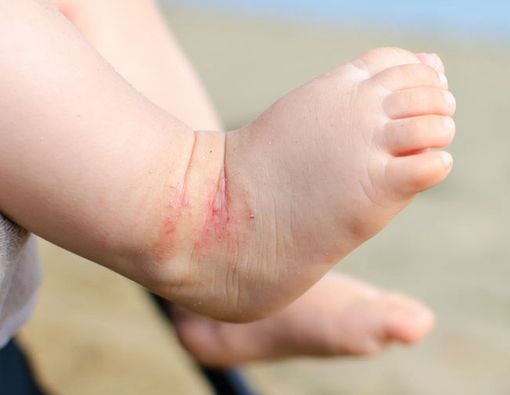 Cegah Eksim pada Bayi dengan Konsumsi Probiotik saat Hamil