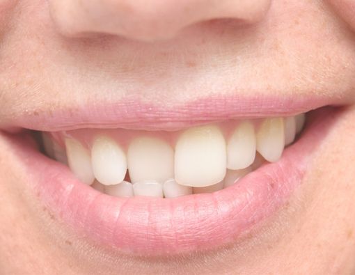 Gigi Gingsul Bisa Picu Pengikisan Akar Gigi, Benarkah?