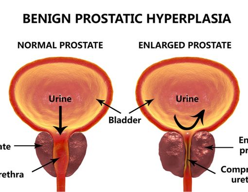 Pembesaran Prostat, Haruskah Dioperasi?