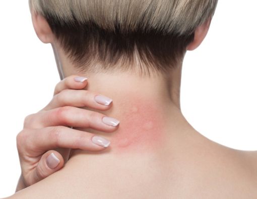 Ruam Seperti Gigitan Serangga Bisa Jadi Gejala Baru Virus Corona