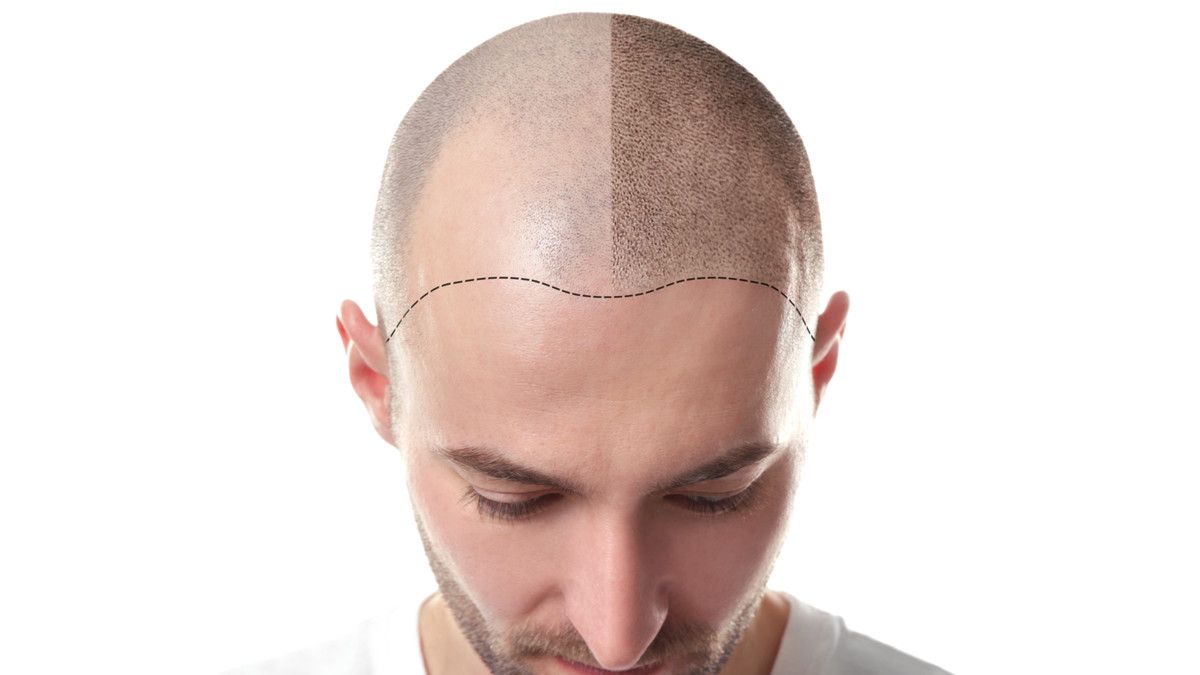 Sebelum Transplantasi Rambut, Ketahui Ini Dulu