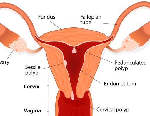 Cara Mengatasi Kondisi Polip Rahim dengan Operasi