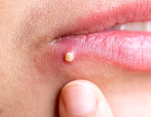 Hindari Yuk, Ini Alasan Jerawat Muncul di Bibir!