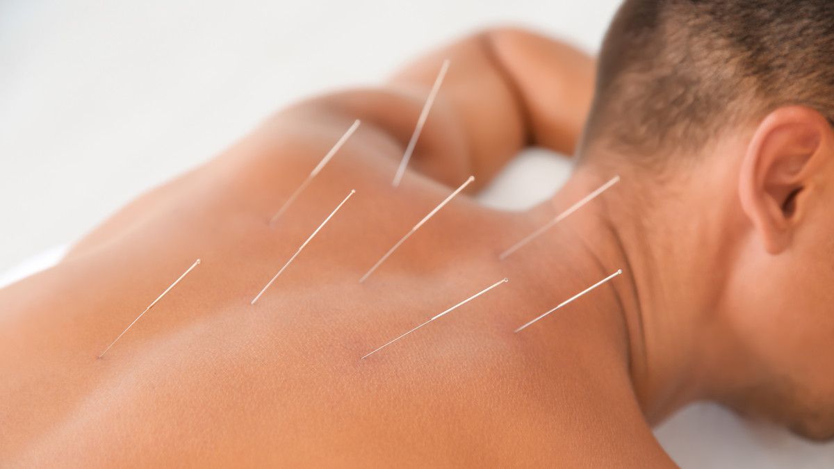 Menikmati Berbagai Manfaat Akupunktur bagi Kesehatan