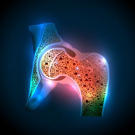 Mengenal Osteoporosis Sekunder