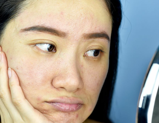 Deretan Penyebab Pori-Pori Besar