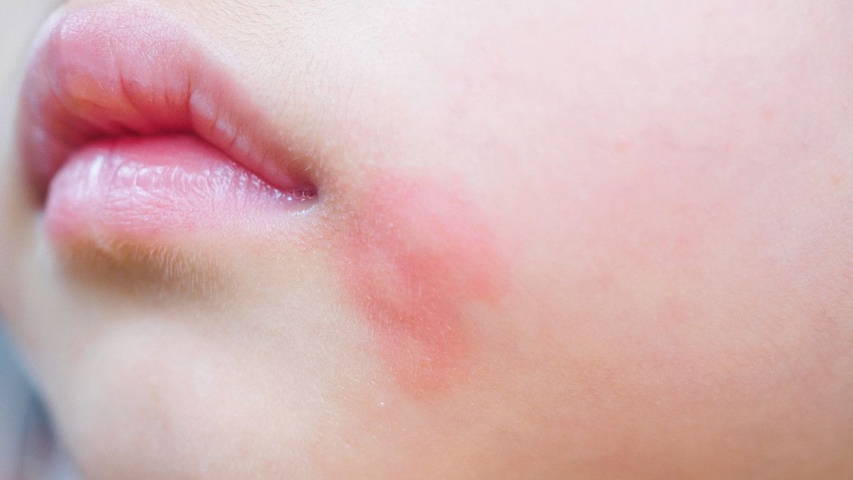 Si Kecil Alergi Susu, Apa yang Harus Bunda Lakukan?