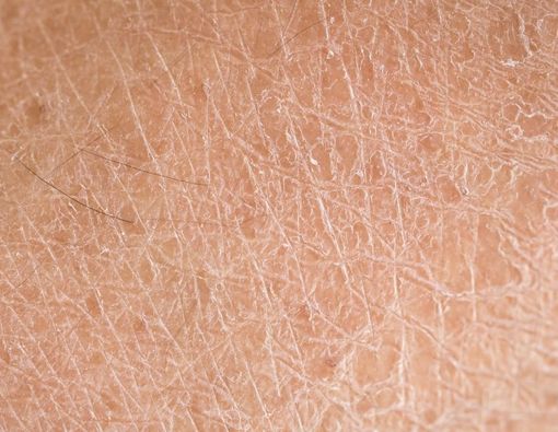 Harlequin Ichthyosis, Kelainan Kulit Langka Akibat Mutasi Genetik