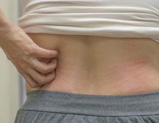 Deretan Penyebab Kulit Gatal Saat Sakit Liver