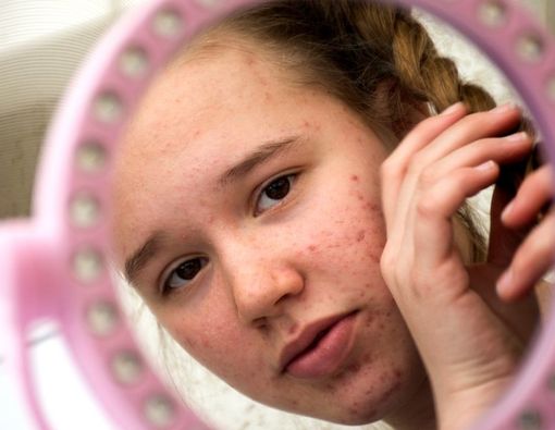 Acne Shaming dan Dampaknya pada Kesehatan Mental