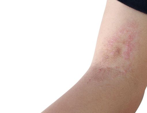 Kenali 7 Ciri-Ciri Kurap Akan Sembuh dalam Waktu Dekat