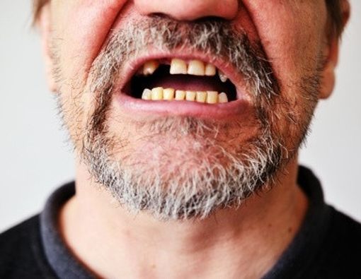 Ompong Karena Gigi Tidak Tumbuh