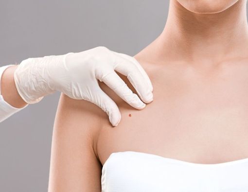 Waspada, Tahi Lalat Bisa Jadi Gejala Kanker Payudara