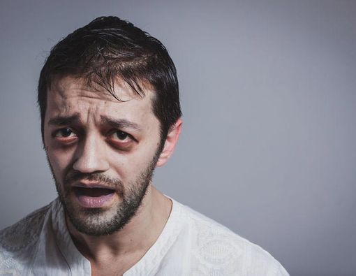 Wajah Pucat, Benarkah Selalu Karena Anemia?