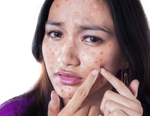 Kebiasaan Buruk yang Bisa Picu Munculnya Jerawat