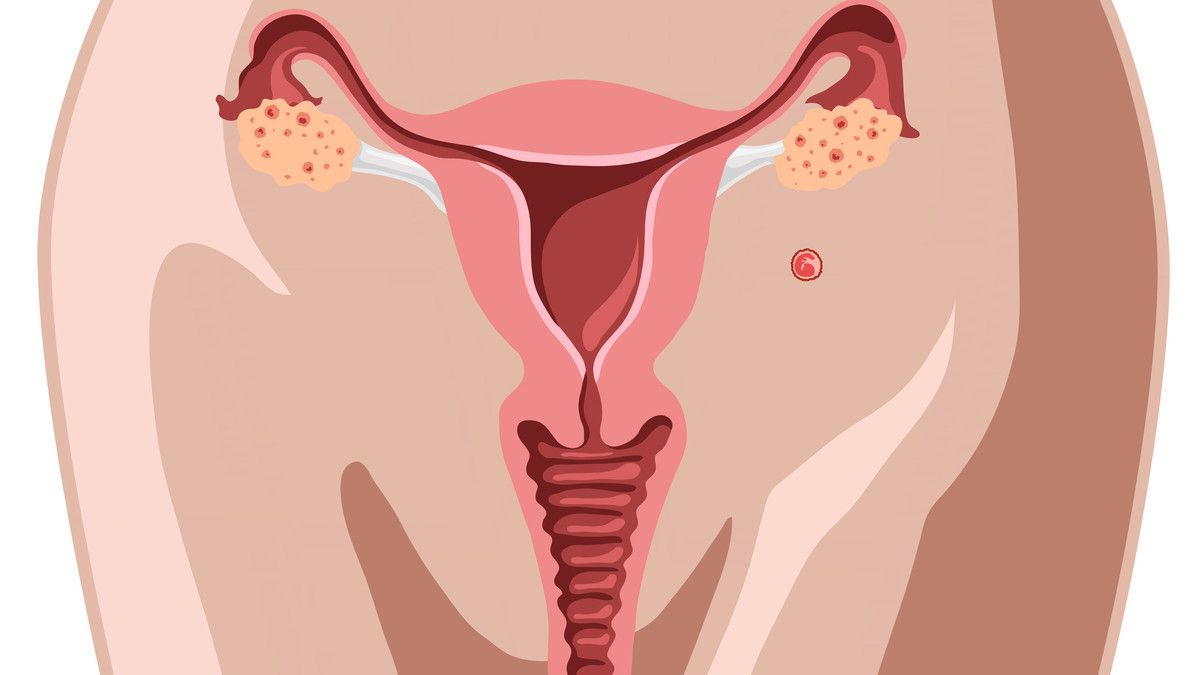 Pengaruh Infeksi Rahim pada Kesuburan