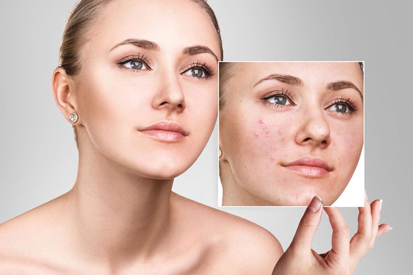 Kiat Memilih Kosmetik untuk Wajah Berjerawat