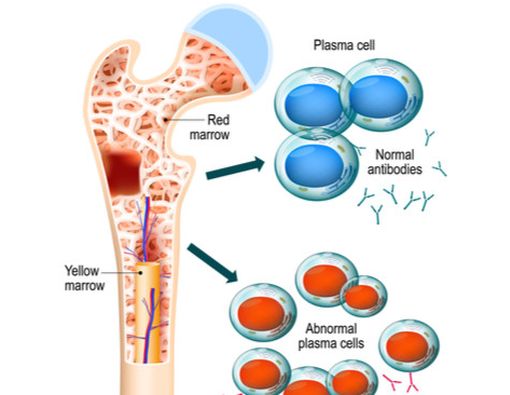 Penyebab Multiple Myeloma yang Harus Diwaspadai