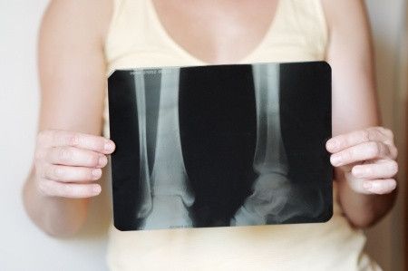Semakin Jarang Bergerak, Tulang Jadi Keropos