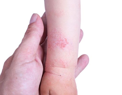 Bercak Merah pada Kulit Anak Tidak Berarti Campak