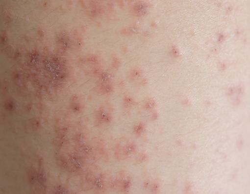 Mengenal Gejala dan Penyebab Dermopati Diabetik