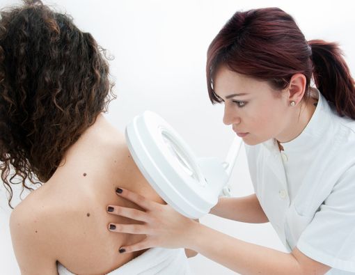 Perbedaan Tahi Lalat Biasa dan Kanker Melanoma