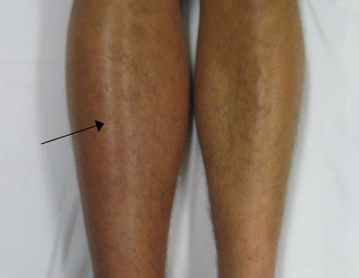 Waspadai DVT Saat Kembali dari Mudik