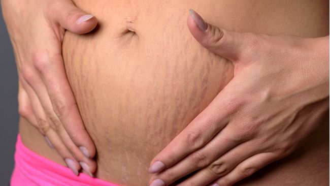 Stretch Mark