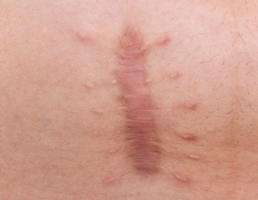 Keloid dan Pengobatannya