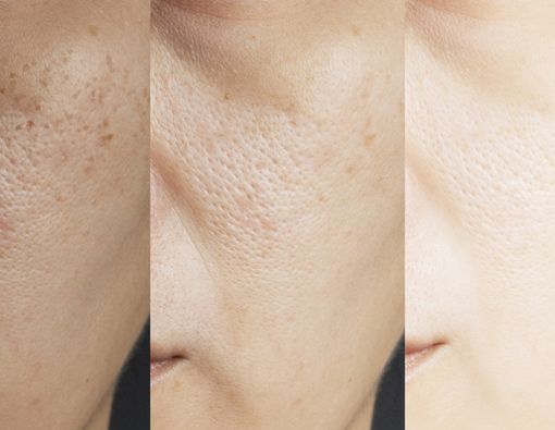 Tren Memutihkan Kulit dengan Glutathione, Amankah?