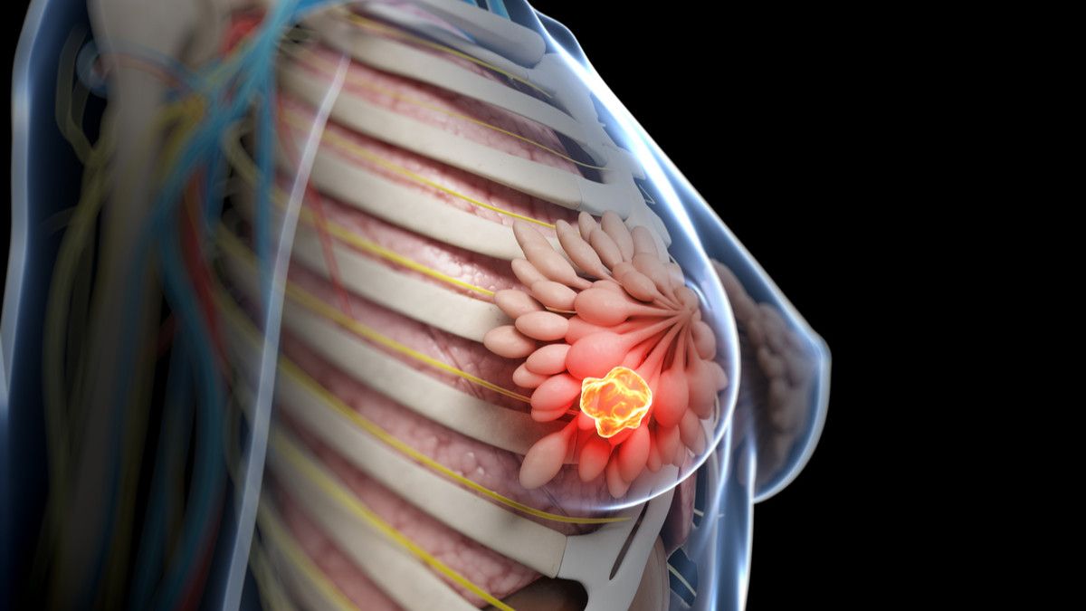 Kanker Payudara Bisa Menyerang Anak, Benarkah?
