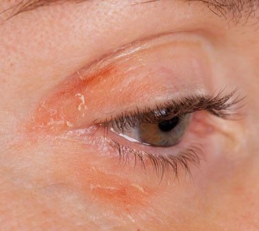 Merokok Terkait Dengan Risiko Psoriasis Lebih Tinggi