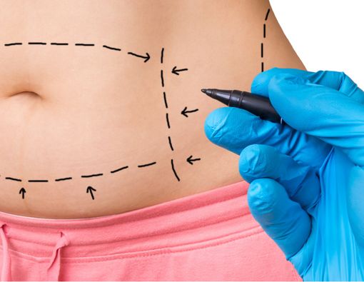 Kondisi yang Harus Diperhatikan Sebelum Melakukan Tummy Tuck