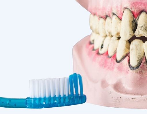 Waspada, Asma Dapat Menyebabkan Infeksi Gusi