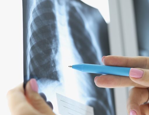 Komplikasi Emboli Paru yang Harus Diwaspadai