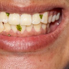 6 Bahaya Membiarkan Makanan Nyangkut di Gigi