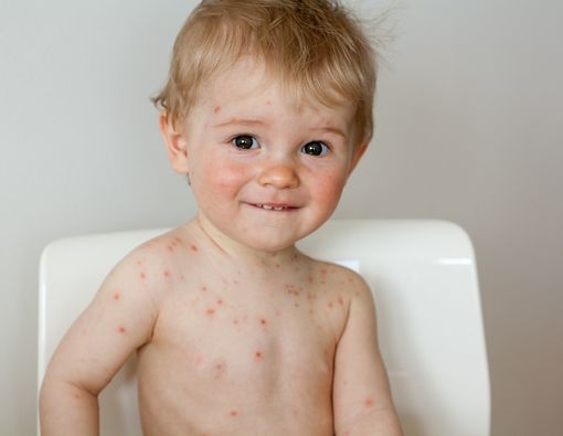 Cacar Air Tak Hanya Menyerang Anak-Anak