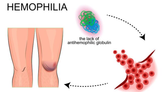 Mengenal Gejala Hemofilia