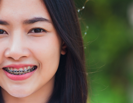 9 Efek Samping Kawat Gigi yang Harus Kamu Tahu