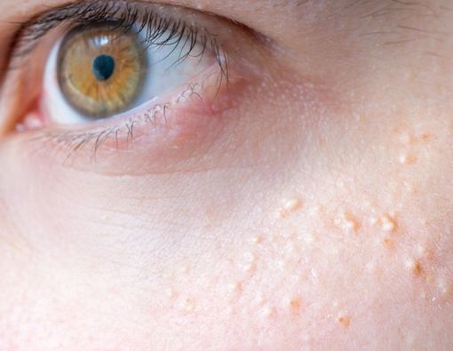 Bukan Jerawat, Ini Benjolan di Wajah yang Harus Diwaspadai