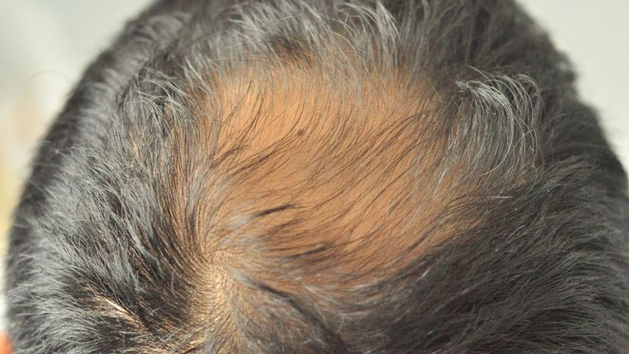 Apakah Rambut Pitak Bisa Tumbuh Kembali? - KlikDokter