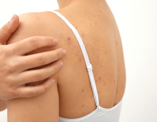 Bahaya Sering Muncul Jerawat di Punggung