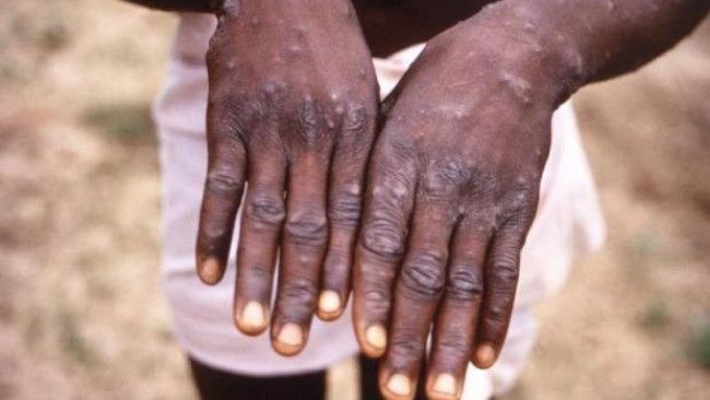 Cacar Monyet atau Flu Babi Afrika yang Lebih Berbahaya?