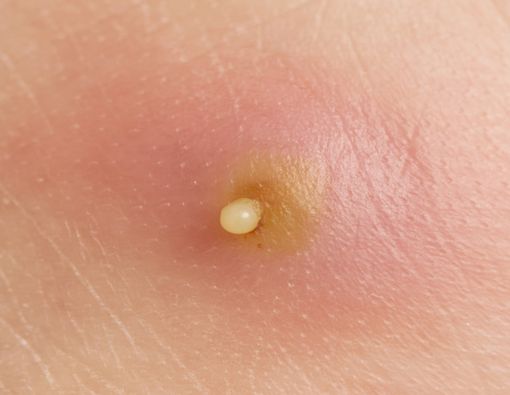 Muncul Bisul di Vagina, Ini Penyebab dan Cara Mengatasinya