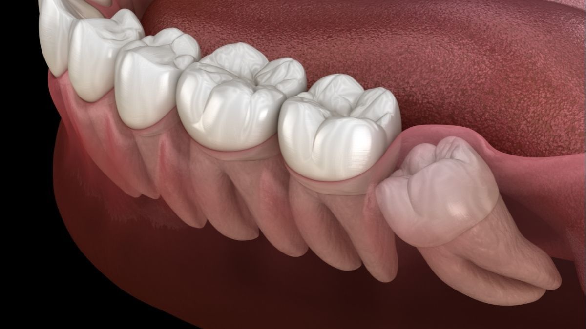 8 Bahaya Jika Gigi Bungsu yang Tumbuh Miring Tidak Dicabut