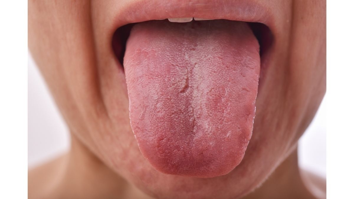 Apakah Fissured Tongue Bisa diobati?